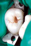 مقایسه‌ ضخامت‌ عاج‌ باقیمانده‌ در زیر پوسیدگی ‌پروگزیمالی‌ در رادیوگرافی Bitewing و نسج‌ دندان‌