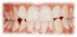 دندان قروچه (براکسیسم)