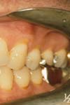 بررسی شیوع و شدت تحلیل لثه در دندان های قدامی و پرمولر بیماران مراجعه کننده به دانشکده دندانپزشکی تبریز
