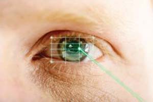 نسل چهارم لیزر برای تصحیح عیوب انکساری چشم