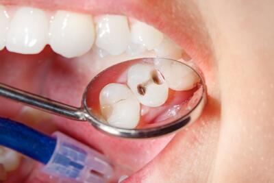 درمان خانگی پوسیدگی دندان با ۱۴ روش کاربردی