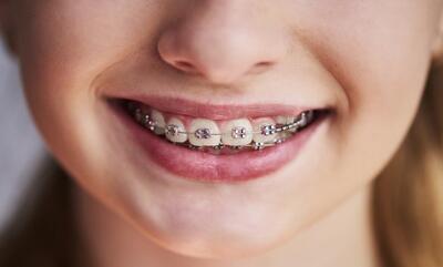 درمان پوسیدگی دندان در خانه + علائم - چی بپوشم