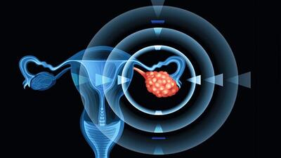 توسعه نانوداروی ضدسرطان تخمدان در ترکیه