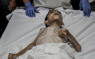 کودکان غزه از گرسنگی جان می‌دهند