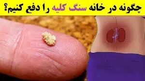 نقش هیدراتاسیون در دفع سنگ‌های کلیه