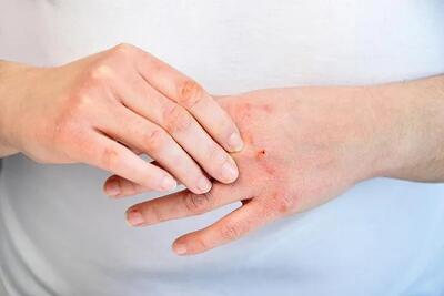 بیماری خود ایمنی پوستی چیست|آیا علائم بیماری خود ایمنی پسوریازیس با HIV یکسان است؟ اندیشه معاصر