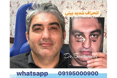 ویدیو نمونه جراحی بینی گوشتی مردانه طبیعی - دکتر بهرام بادامچی جراح و متخصص گوش و حلق و بینی