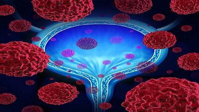 راهکار کاهش پیشروی سرطان مثانه