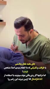 بلفاروپلاستی