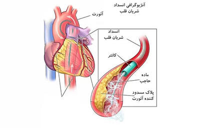 آنژیوگرافی چیست؟