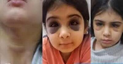 آزار وحشتناک دختربچه ۷ ساله سنندجی توسط نامادری