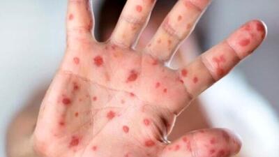ابتلای ۱۱ کودک جاسکی به سرخک؛ واکسن موجود است
