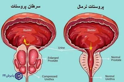علائم سرطان پروستات بدخیم چیست؟