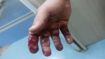۵۷ نفر در حادثه چهارشنبه آخر سال قم مصدوم شدند /   از قطع انگشت تا سوختگی شدید
