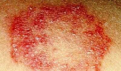 عفونت قارچی مداوم در برخی از بانوان چه دلایلی دارد؟