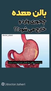 بالن معده چیست؟ + فیلم