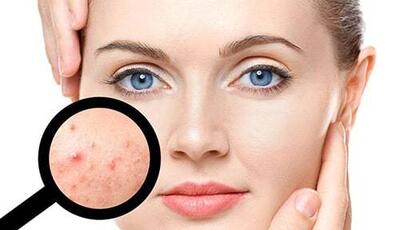 جوش و آکنه؛ چه کنیم که جوش نزنیم؟