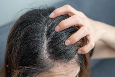اگزما پوست سر چیست و چه علائمی دارد؟