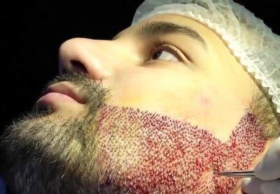 همه چیز در مورد عوارض کاشت ریش
