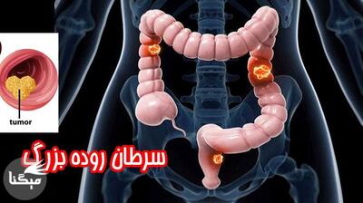 میگنا - افزایش نگران‌کننده سرطان روده بزرگ در جوانان