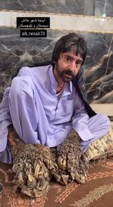 فیلمی ناراحت‌کننده از بیماری عجیب مرد درختی در سیستان و بلوچستان