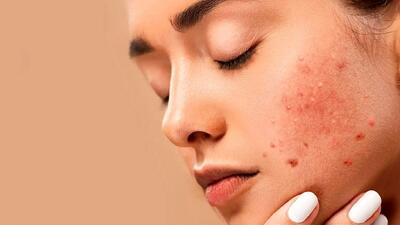 مهم‌ترین نکاتی که باید برای از بین بردن آکنه بدانید