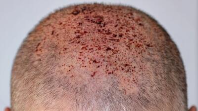 علت و علائم عفونت بعد از کاشت مو ، چه باید کرد؟