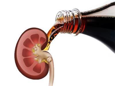 سنگ کلیه دوست دارید، نوشابه بخورید