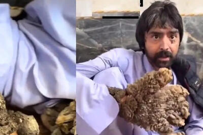 شگفتی های مرد درختی؛ راز عجیب‌ترین بیماری جهان در ایران!