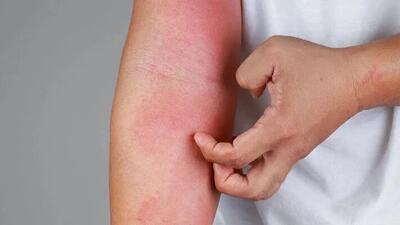 چگونه از شر خارش و التهاب در بهار رها شویم؟