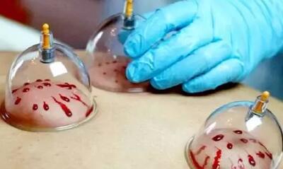 چه زمانی حجامت کنیم/حجامت میگرن را درمان می‌کند؟