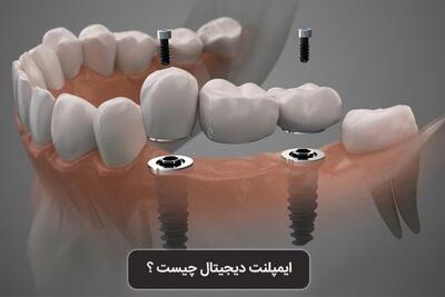 ایمپلنت دیجیتال در تهران - هزینه و مزایا دکتر ادیب 1404 - خبرنامه