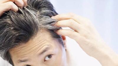 آنچه باید از ریزش موی سکه‌ای بدانید