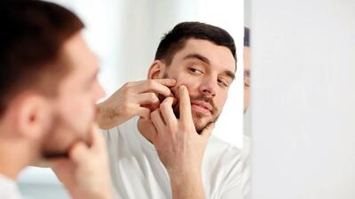 با این 5 ماده‌ آکنه هایتان را نابود کنید
