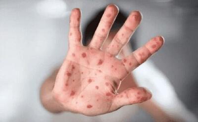 آبله مرغان چیست/ علائم+ روش‌های درمانی+ واکسن