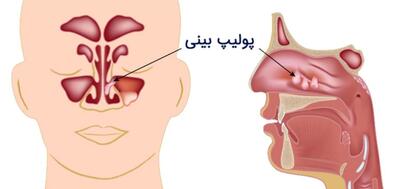 علائم پولیپ بینی که نمی‌دانستید + پیشگیری و نحوه درمان