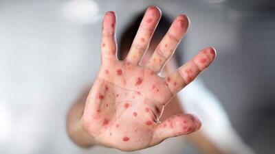 شیوع سرخک منجر به مسمومیت ویتامین A می‌شود