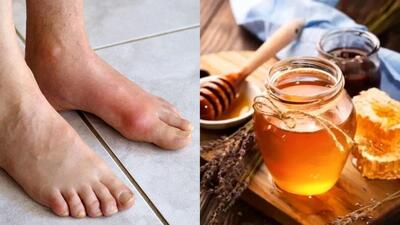 تاثیر عسل بر درمان نقرس / خواص و روش های مصرف