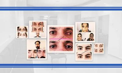 بازسازی چهره و پیشگیری از عوارض پس از تخلیه چشم با پروتزهای چشمی پیشرفته