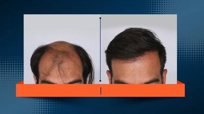 جدیدترین روش کاشت مو در ایران و جهان