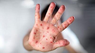 سومین فوتی ناشی از ابتلا به سرخک در آمریکا