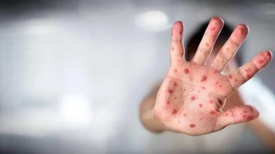 هر آنچه که باید درباره بیماری آبله بدانید