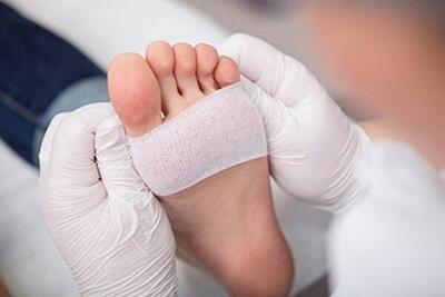 تولید زخم‌پوش‌های دولایه از پیله ابریشم و جلبک برای کاهش خطر عفونت