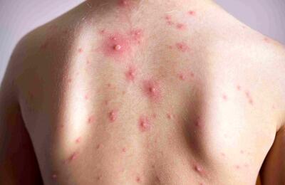 آبله‌مرغان چند روز واگیر دارد؟