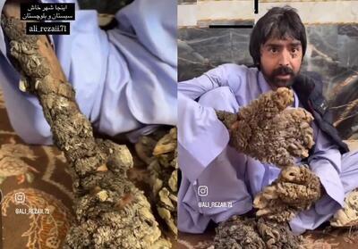 مرد درختی ایران در آمریکا جراحی شد+ اولین عکس منتشر شده از عبدالنصیر