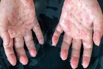 شناسایی مورد جدید سویه Ib آبله میمون در بریتانیا