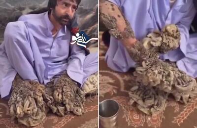 نخستین عکس مرد درختی بعد از عمل جراحی در آمریکا! + عکس