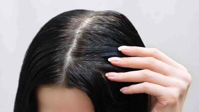 نکاتی برای جلوگیری از ریزش مو از منظر طب سنتی