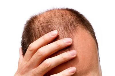 برای جلوگیری از ریزش مو چه بخوریم