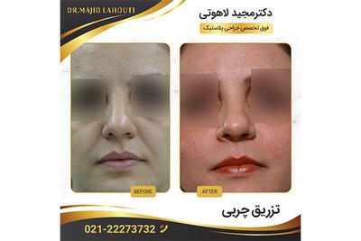 همه چیز راجب تزریق چربی به صورت: راهی برای زیبایی طبیعی و ماندگار
